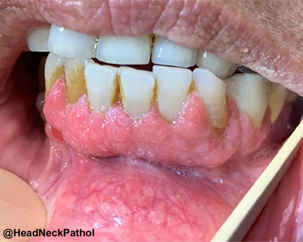 Head Neck Pathol tweet media