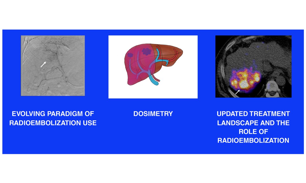 HepatomaRes's tweet photo. ☢️ Radioembolization for #HepatocellularCarcinoma

This review summarizes updated strategies and evolving clinical applications of #radioembolization in HCC, highlighting recent #guideline updates and its expanding role in locoregional therapy.

🔗 [https://t.co/untMBsZSrg] https://t.co/AVZc8SKdSC