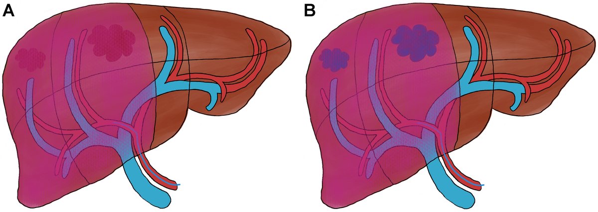 HepatomaRes's tweet photo. ☢️ Radioembolization for #HepatocellularCarcinoma

This review summarizes updated strategies and evolving clinical applications of #radioembolization in HCC, highlighting recent #guideline updates and its expanding role in locoregional therapy.

🔗 [https://t.co/untMBsZSrg] https://t.co/AVZc8SKdSC