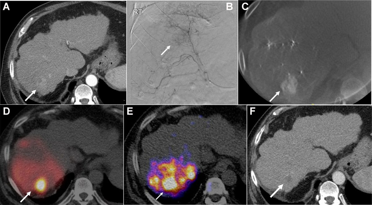 ☢️ Radioembolization for #HepatocellularCarcinoma

This review summarizes updated strategies and evolving clinical applications of #radioembolization in HCC, highlighting recent #guideline updates and its expanding role in locoregional therapy.

🔗 [f.oaes.cc/xmlpdf/59b51d4…]