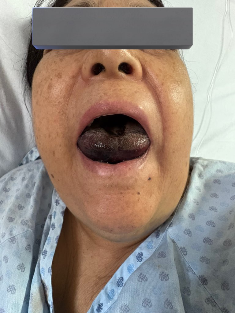 🧵 Caso clínico del
Día en #Urgencias 🚑‼️

👩‍🦳 Paciente femenina de 69 años acude al servicio de urgencias acompañada de sus familiares, muy espantados, porque al despertar notaron que su lengua estaba de color NEGRO 😨👅.

Se fue a dormir en condiciones normales y amaneció con