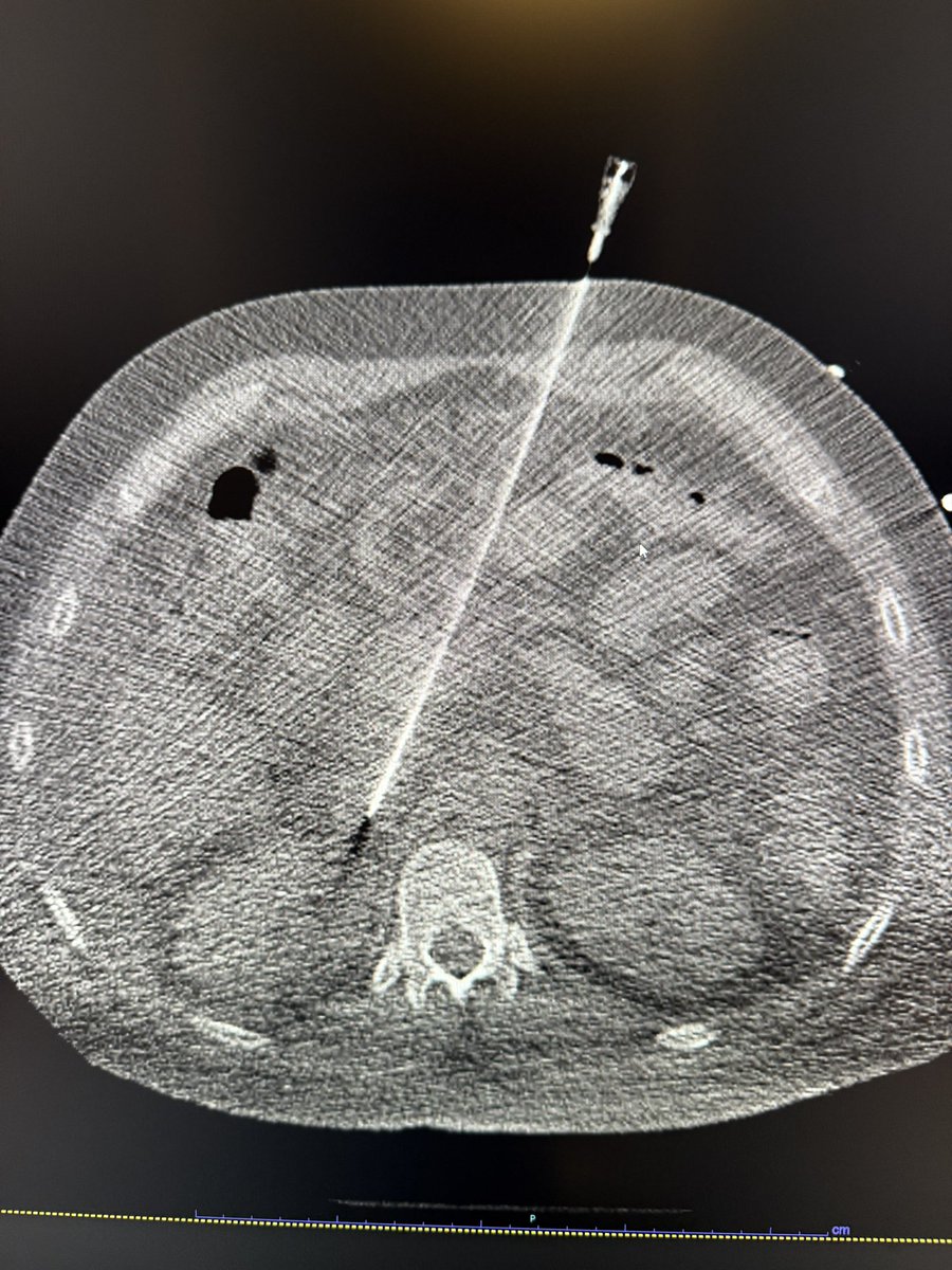 ChengaziMD's tweet image. It was one of those days, #chogazi back at it again.

Haven’t been posting many cases coz X has been atrocious recently, but we did perc esophageal varix embo with mesocaval shunt on this one - should I post more? @beckcj