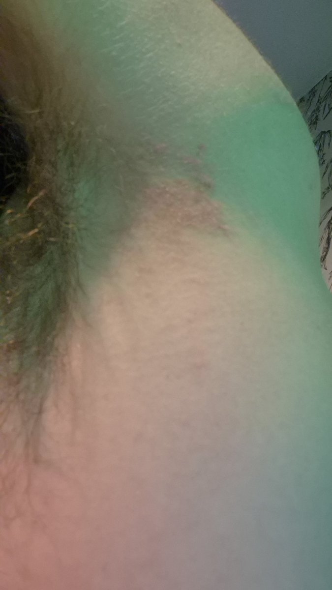 pelpezperry's tweet photo. Breaking out in rashes, likely to be stress related too! I have no time for this. https://t.co/usV2BEaU8d