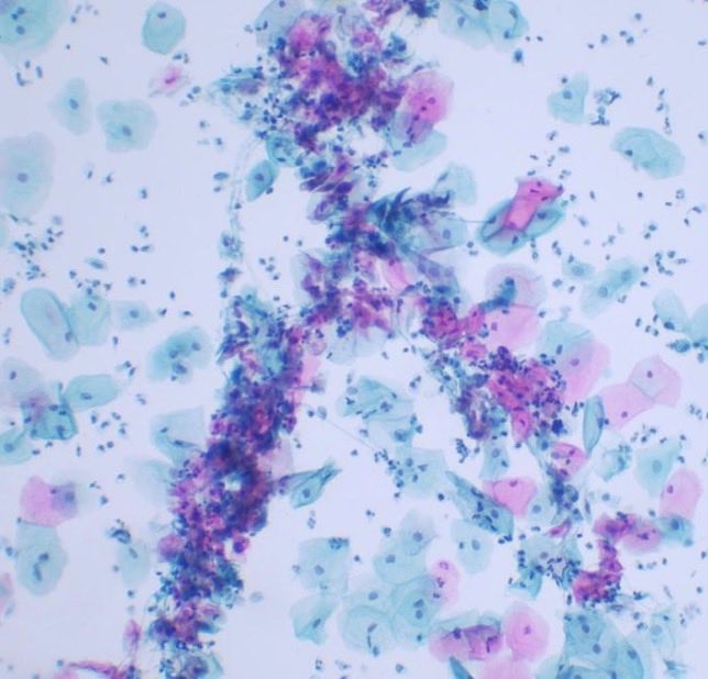JCandidoXavier's tweet image. Are you hungry? Can you see a shish kebab? 😂😂😂
Candidiasis on cervical cytology (SurePath).

#path #pathology #cevicalcytology