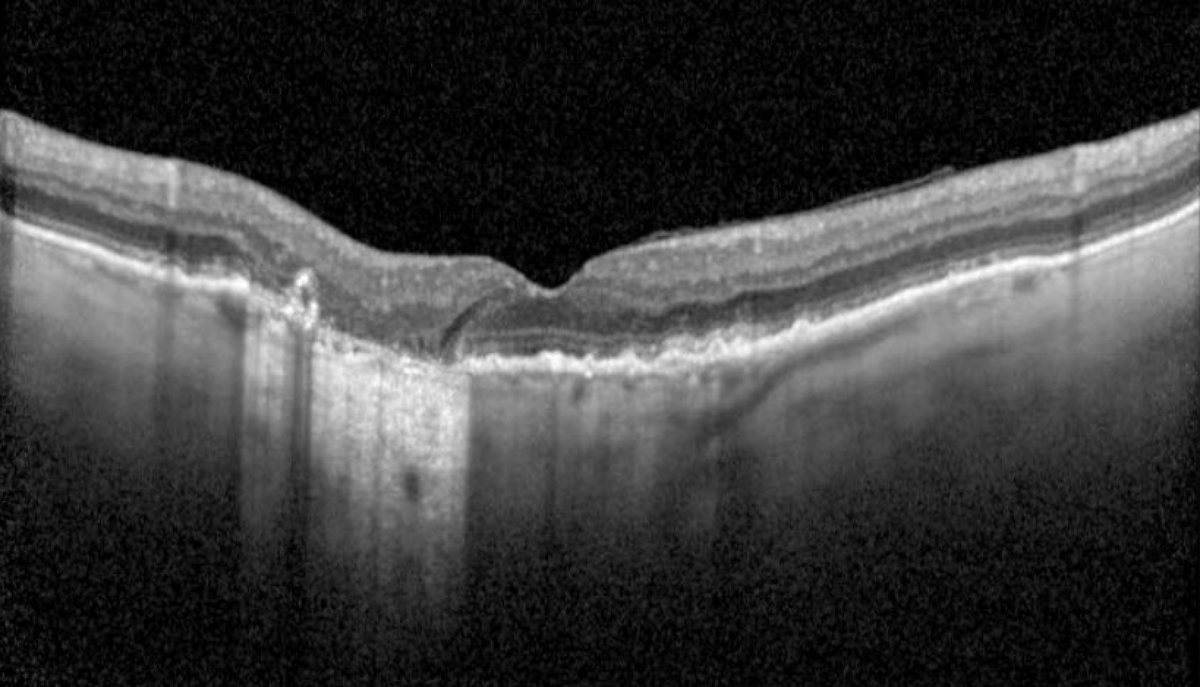 RetinaSociety's tweet photo. Non-foveal geographic atrophy in eye with dry age-related macular degeneration. https://t.co/tyi0kAzpPb