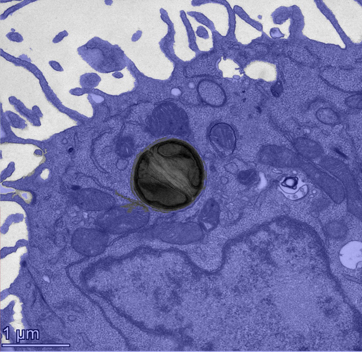 On Feb. 4, a Cell study from Westlake University led by Prof. Shang Cai's team revealed that intratumor bacteria influence cancer metastasis and recurrence depending on whether they reside inside or outside cancer cells.

Intracellular bacteria activate the cGAS–STING–IL17B
