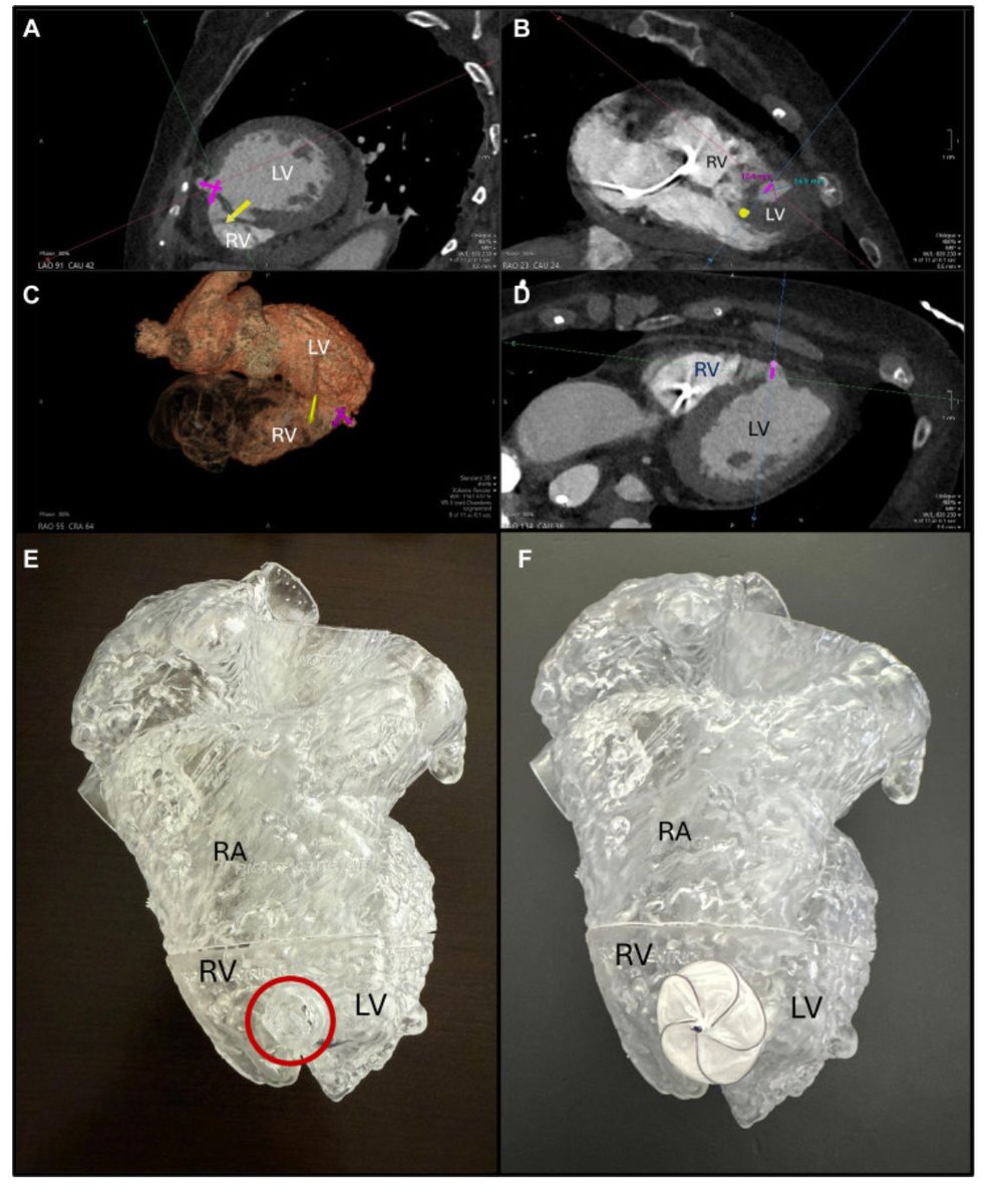 RCubedduMD's tweet image. Heroic save following AMI Shock in a patient with double insult: ventricular pseudoaneurysm and VRS.  #innovation #heartteam @NCHRooneyHeart @JACCJournals #Shock #AMI @ACCinTouch @JACCJournals @DeeDeeWangMD @PU84  @DrBrianSolomon 
sciencedirect.com/science/articl…