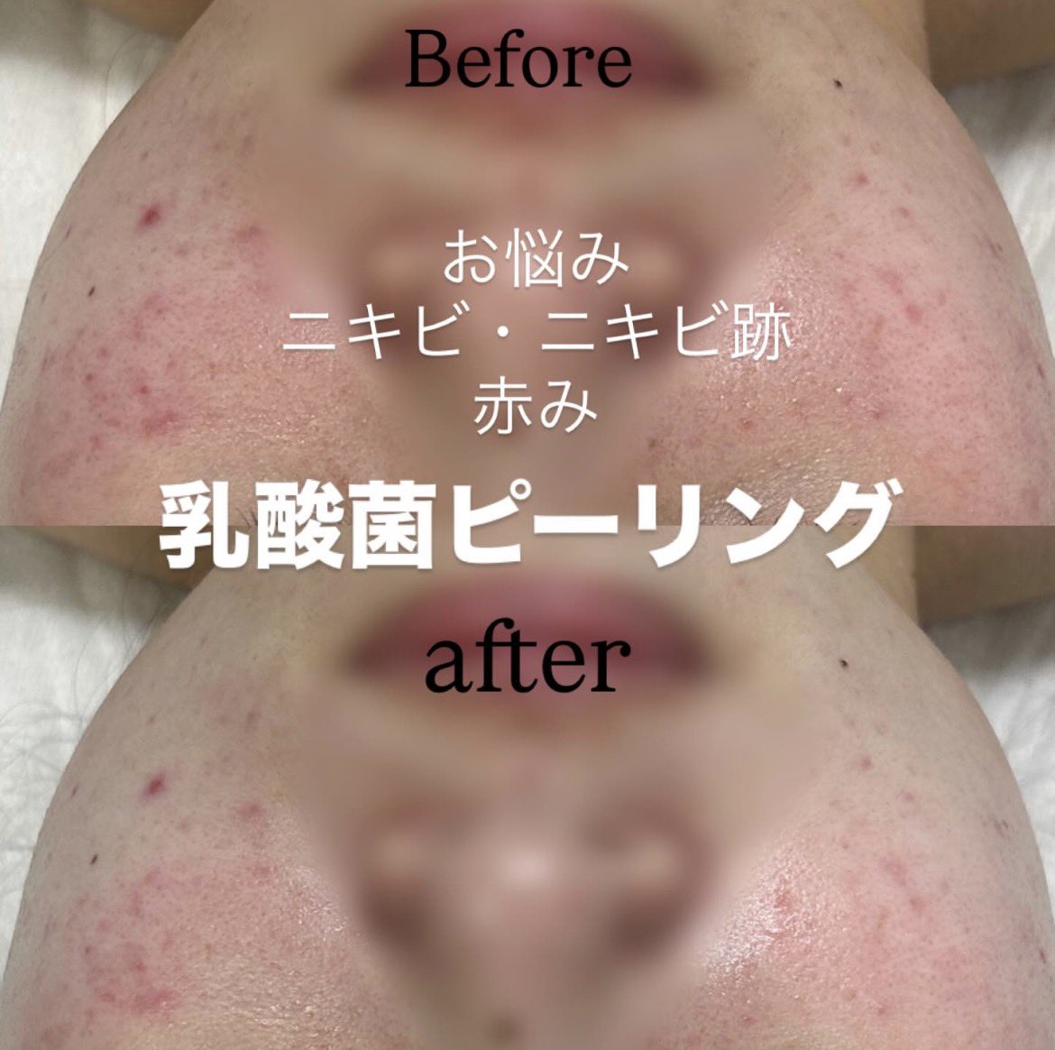 peacesign0625's tweet photo. 【お客様Before/after】
乳酸菌ピーリングでの肌質改善です🍼
気温差や花粉でお肌が揺らぎやすい時期になってきます😢
お肌が敏感になってしまっている時は、トラブルもつきもの、、
大きくお悩みが出てくる前に、一緒にお肌改善していきましょう💪 https://t.co/2hAk4aKjFB
