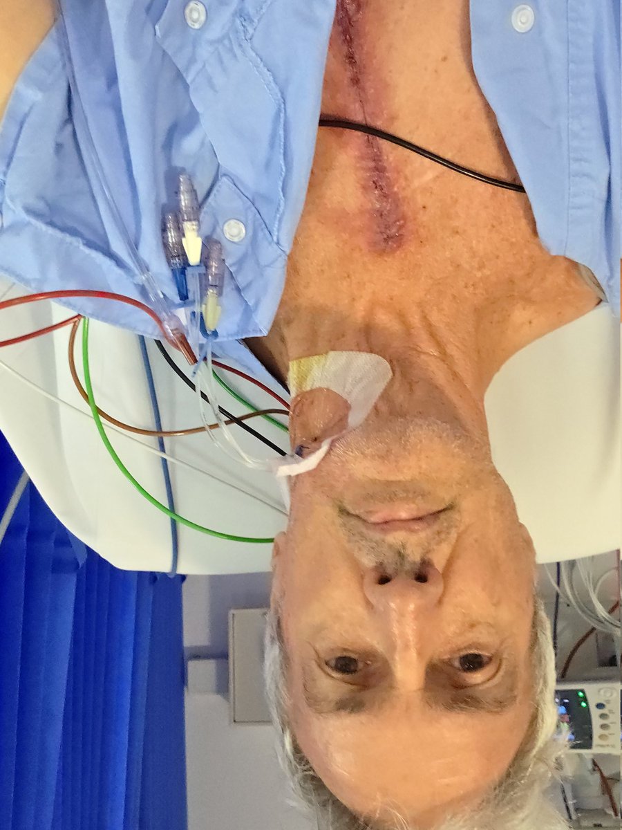 Open heart surgery(6Hrs) yesterday morning Back in the Ward out of ICU great work Dr Ben Anderson and the nurses( should always mention nurses first they were unbelievable John Flynn
