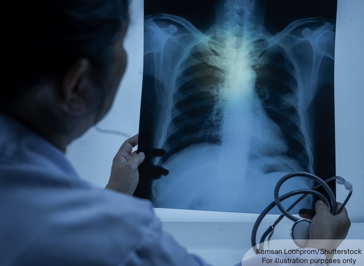 NewsBFM's tweet photo. A tuberculosis cluster has been detected in Kota Tinggi, Johor, with 33 cases confirmed as of February 4.

One death has been reported within the cluster; however, the state health department has confirmed that it was not caused by tuberculosis.

All affected individuals are currently receiving treatment and are under close monitoring at nearby health facilities.