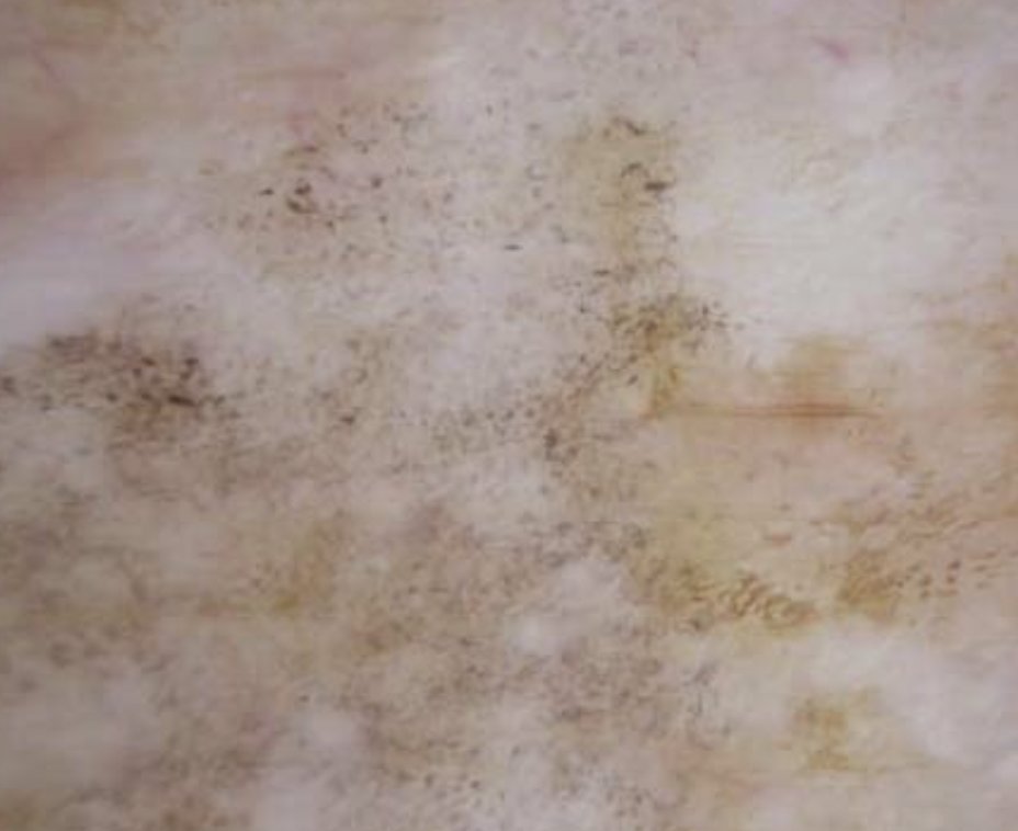 DermMarianne's tweet photo. 1⃣ Dermoscopic structure a day
🧂 Peppering: gray pepper-like granules
🔬Free melanin and/or melanophages in the dermis
Can be associated with regression or inflammation
#dailyscope https://t.co/pDEf9UU8wd