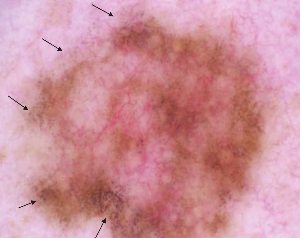 DermMarianne's tweet photo. 1⃣ Dermoscopic structure a day
🧂 Peppering: gray pepper-like granules
🔬Free melanin and/or melanophages in the dermis
Can be associated with regression or inflammation
#dailyscope https://t.co/pDEf9UU8wd