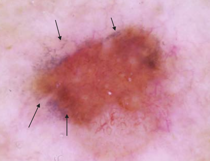 DermMarianne's tweet photo. 1⃣ Dermoscopic structure a day
🧂 Peppering: gray pepper-like granules
🔬Free melanin and/or melanophages in the dermis
Can be associated with regression or inflammation
#dailyscope https://t.co/pDEf9UU8wd