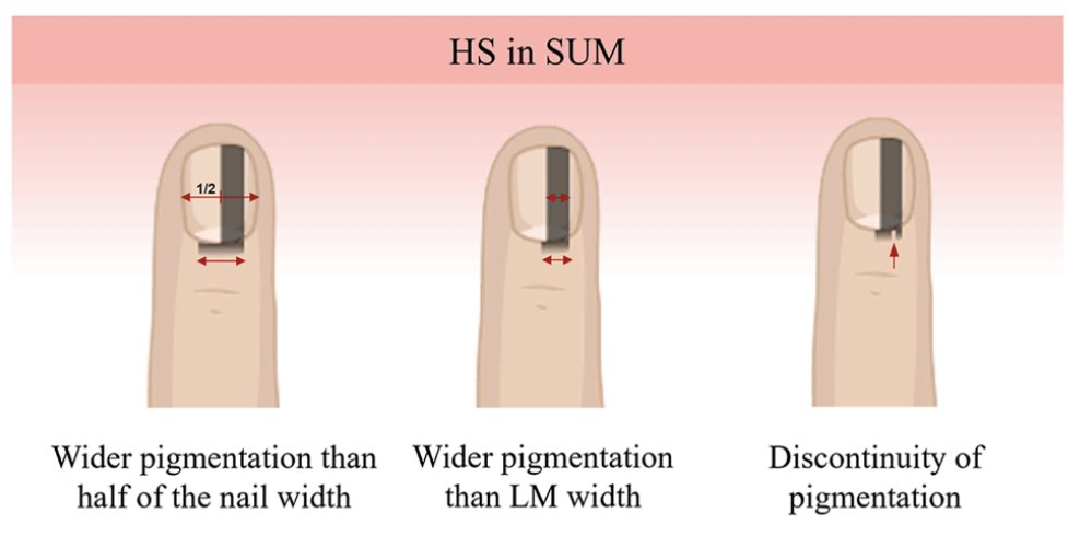 DermMarianne's tweet photo. 📒HS: true periungual extension of brown-black pigment onto the surrounding nail folds 

📒Pseudo-HS: apparent extension of pigmentation visible through the transparent nail folds https://t.co/VaB5TNDopV