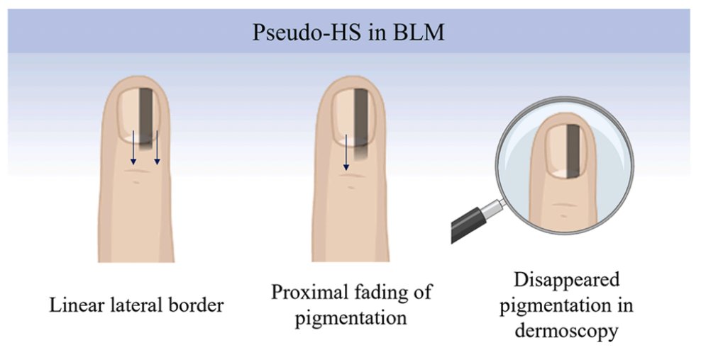 📒HS: true periungual extension of brown-black pigment onto the surrounding nail folds 

📒Pseudo-HS: apparent extension of pigmentation visible through the transparent nail folds