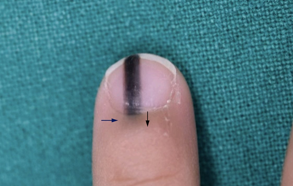 DermMarianne's tweet photo. 🇰🇷 A Korean study found Hutchinson’s sign in 82.9% of subungual melanoma (left), while pseudo-Hutchinson’s sign occurred in 44.8% of benign longitudinal melanonychia (right) https://t.co/Rd162c4Mw4