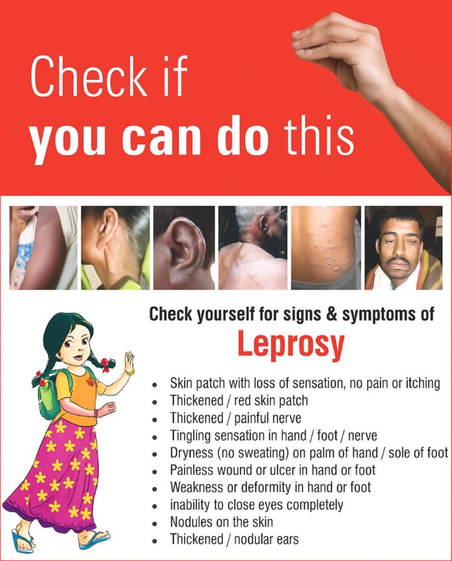 Indiagovin's tweet image. Check early signs of Leprosy. Seek treatment early.
Free diagnosis and treatment are available at Government health facilities.
Early care prevents disability.
#LeprosyAwareness #EndStigma #LeprosyFreeIndia #HealthForAll