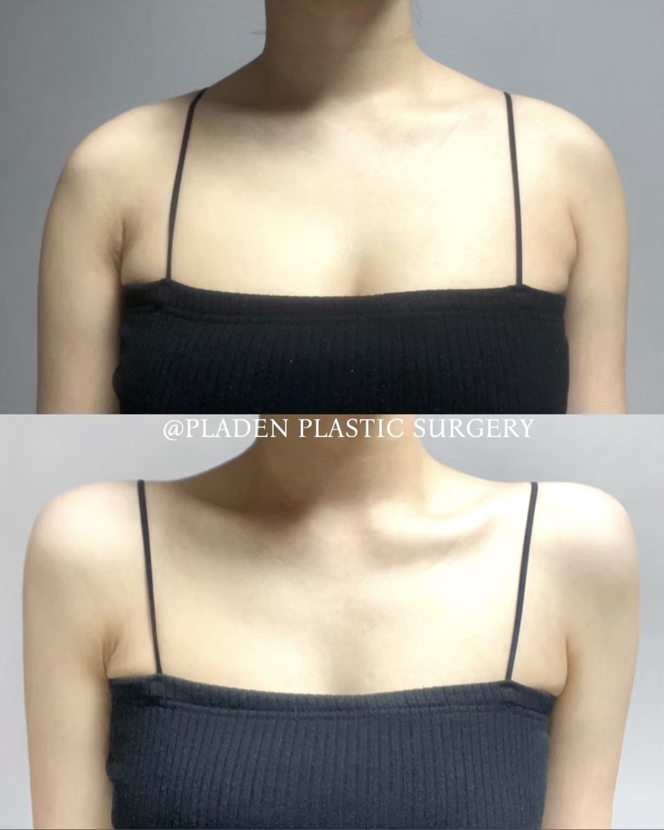 Qchan_biyou's tweet image. aespaのニンニンみたいな直角肩になりたくて肩フィラー調べてたんだけど、ここの症例肩だけ見たらもろニンニンでバビ。