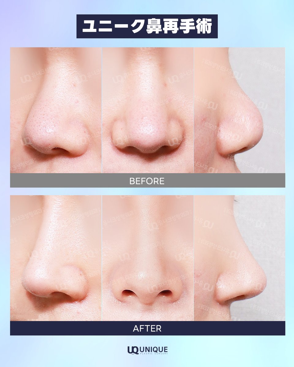 unique__jp's tweet image. #鼻再手術
【ユニーク鼻再手術】💎

派手すぎず、
でも確実に綺麗になれるのが
ユニークの強み🕊️

横顔に自信が持てるようになって
毎日幸せです！

気になった方は、
✉️ line.me/ti/p/ASaI14sy4x

#ユニーク美容外科 #鼻整形 #鼻先 #韓国整形 #症例写真