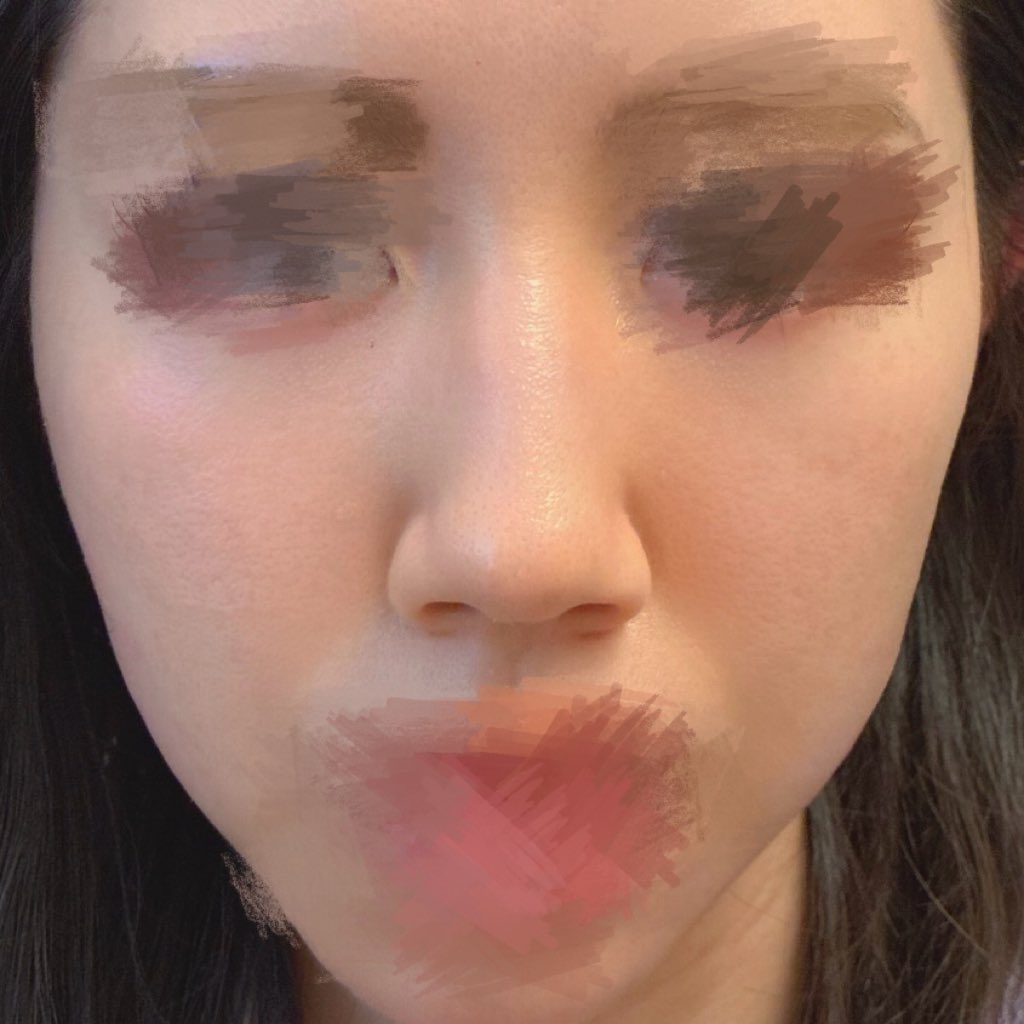 ohanagaitaiyo's tweet photo. 鼻フル・猫手術をしてから1ヶ月！
FINT美容外科で施術していただきました✨
まだ腫れはありますが、横・正面・斜め、どの角度から見ても綺麗な鼻で、本当に手術してよかったです。
鼻筋や鼻先はこれからさらに細くなっていくそうなので、今後の変化も楽しみです🩷
1、2枚目Before、3、4枚目Afterです！ https://t.co/yyFGjEj1Ky