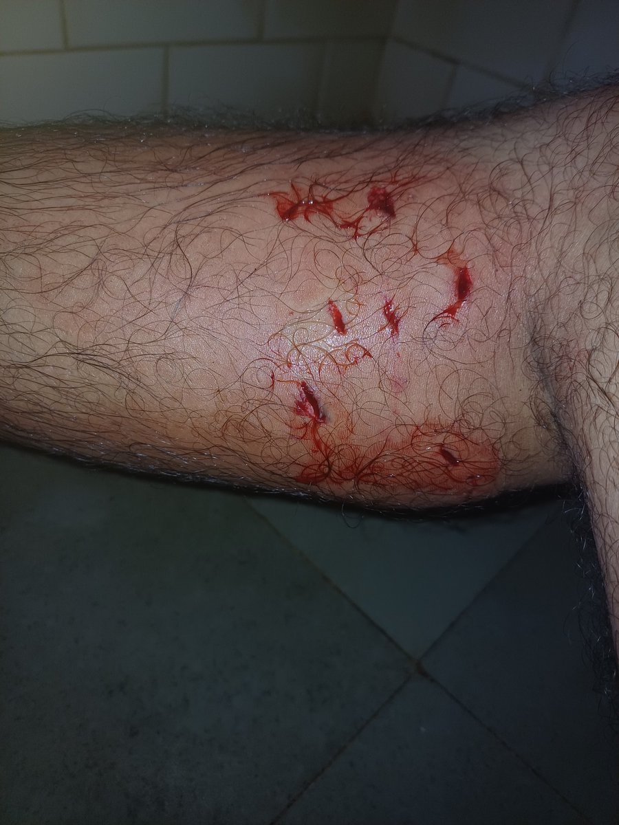 <a href="/i_m_harshitsing/">Harshit Singh</a> <a href="/amitkilhor/">amit kilhor</a> <a href="/BalambalMurali/">S. Muralidharan</a> <a href="/kartik_chau/">KARTIK CHAUDHARY</a> <a href="/NCMIndiaa/">NCMIndia Council For Men Affairs</a> <a href="/hightemperX/">Temper Issues</a> <a href="/Kapur2Sandy/">Sandy Kapur</a> <a href="/KartiPC/">Karti P Chidambaram</a> <a href="/RiyazAh82248419/">Riyaz Ahmed</a> <a href="/SaveIndia28700/">Save India</a> <a href="/Uncaredcitizen/">Indian Citizen</a> I was bitten by street dog from behind on 1 Feb 2026 when I was just walking on road in Vasai West.

I have attached photo of injury on right leg and doctors prescription. 

No street is safe in India for pedestrians due to stray dogs. 

<a href="/snehadubepandit/">Sneha Dube Pandit</a> <a href="/BJP4India/">BJP</a> <a href="/narendramodi/">Narendra Modi</a>