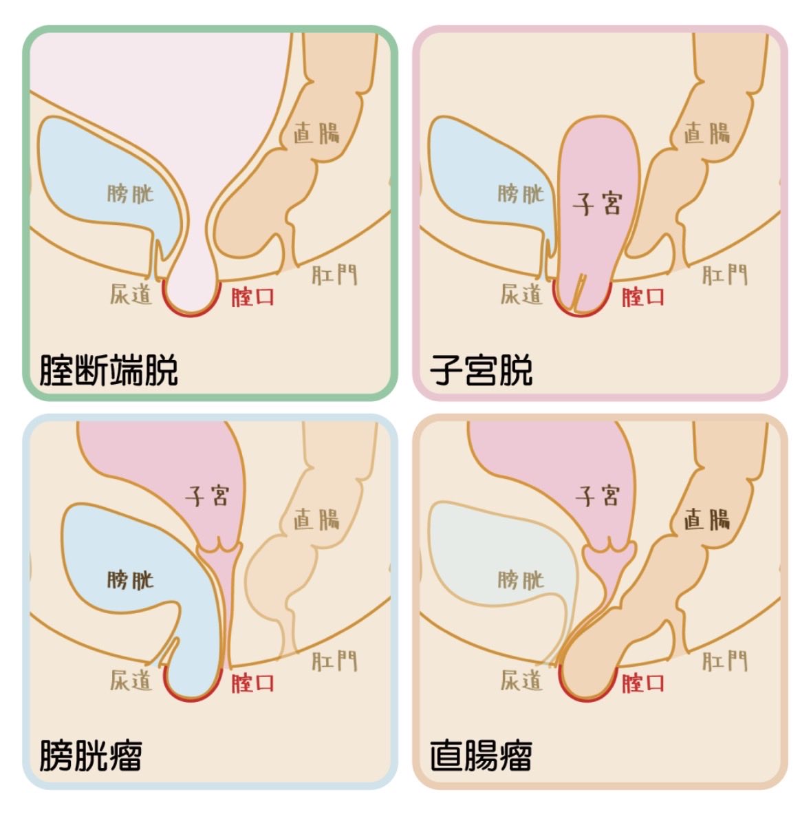 ryoko_dr_LunaCL's tweet photo. お風呂で「ピンポン玉みたいなもの」に触れて驚いたことはありませんか？

悪いデキモノかも…と不安になりますが、多くは「膀胱脱」や「子宮脱」という状態です。骨盤の筋肉や靱帯の緩みで膀や子宮が下がってくるもので、適切な治療で改善します。 https://t.co/9ZK4L5OEdD