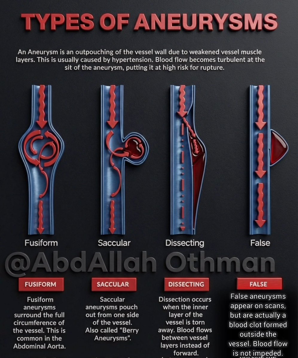 CardioBeat_'s tweet image. Aneurysm Types 👇🏻✅ facebook.com/share/p/1AoZzf…
Fusiform ↔️: Symmetrical dilation, often abdominal aorta.
Saccular 🎈: One-sided bulge, "berry" shape.Dissecting 🩸: Tear in inner layer, false lumen.
False 🩹: External clot, appears as bulge.
#Cardiology #Aneurysm #VascularHealth