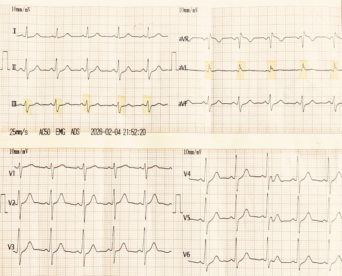 mRafiHamidi's tweet photo. ECG Warm-Up
Yesterday, a 59YM, a UK citizen residing in Manchester, presented to my clinic for a routine medical check-up. He was asymptomatic but sought evaluation because his uncle had passed away a few days earlier due to SCD. 

Below is his ECG.

What are your thoughts? https://t.co/b1lxdNvDpq