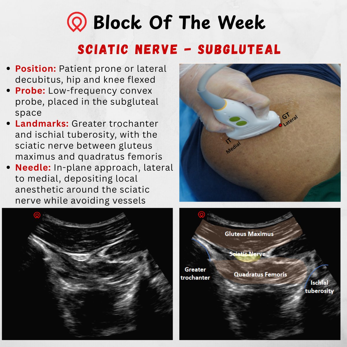 Block of the Week | Subgluteal Sciatic Nerve

Kicking off this week’s Block of the Week with the Subgluteal Sciatic Nerve.
A quick, image-based post to support ultrasound learning and daily practice.

#Ultrasound #RegionalAnesthesia #Anesthesia #PainManagement  #Wisonic