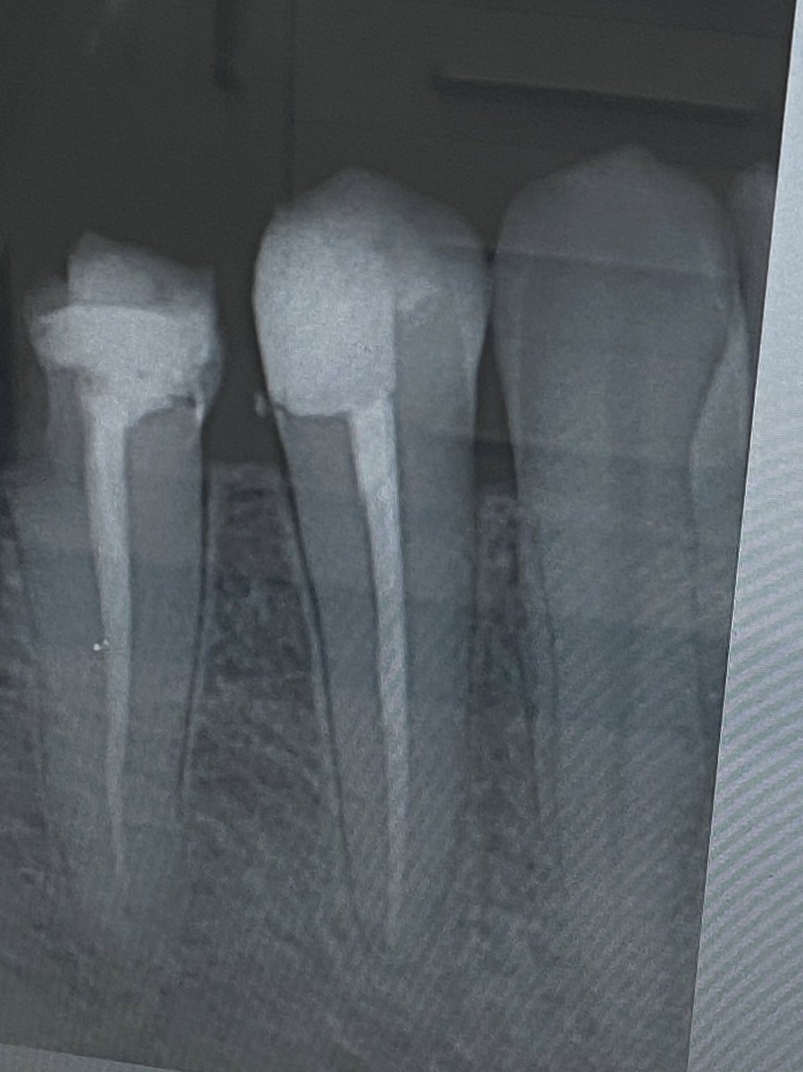 abdullahdento's tweet photo. Why come twice when once is enough
Single visit RCT ✅ 

#dental_abdullah https://t.co/yD7uwAh5HW