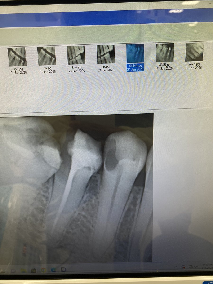 abdullahdento's tweet photo. Why come twice when once is enough
Single visit RCT ✅ 

#dental_abdullah https://t.co/yD7uwAh5HW