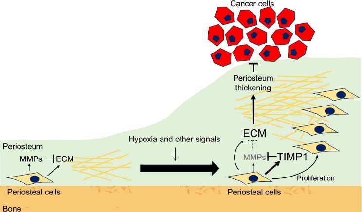 jcaopl's tweet photo. âš#CancerScience 2/2026 ãã€ã©ã€ãè«æçŽ¹ä»âš
Stromal Defense Against Cancer: An Unprecedented Mechanism Limiting Cancer Invasion Into the Bone
Masayuki Tsukasaki1,2, Hiroshi Takayanagi3 et al.
1: Department of Biochemistry, Showa Medical University School of Dentistry, Tokyo, Japan
2: Center of Excellence in Precision Medicine and Digital Health, Department of Physiology, Faculty of Dentistry, Chulalongkorn University, Bangkok, Thailand
3: Department of Immunology, Graduate School of Medicine and Faculty of Medicine, The University of Tokyo, Tokyo, Japan
é é žéšæå¹³äžç®çïŒHNSCCïŒã¯å£è
ãåŒåžåšç³»äžç®ã«ç±æ¥ããããã§ãé²è¡ãããšé¡éªšãžæµžæœ€ããäºåŸãçæŽ»ã®è³ªãèããäœäžãããŸãã骚浞最ã«é¢ããå åã¯å ±åãããŠããŸãããè
«çãšéªšé¢é£çµç¹ã®çžäºäœç𿩿§ã¯æªè§£æãªç¹ãå€ãæ®ãããŠããŸããTsukasaki Mããã³Takayanagi Hã¯ãHNSCCã®éªšæµžæœ€ã«ãããååã»çŽ°èæ©æ§ãæŠèª¬ãã骚èã®åœ¹å²ã«æ³šç®ããŸãããããŠã¹ã¢ãã«è§£æãããè
«çè¿åã§ã¯éªšèæå·ããªããŠãäœé
žçŽ ç°å¢ã«ããHIF-1αã·ã°ãã«ã掻æ§åãããTIMP1ç£çãä»ããŠéªšèè¥åãçããããšã瀺ãããŸããããã®è¥åãã骚èã¯äžæçã«ãã现èã®éªšæµžæœ€ãæå¶ããŸãããHNSCCã§ã¯éå°ãªã¿ã³ãã¯è³ªåè§£é
µçŽ ç£çã«ããé²åŸ¡æ©æ§ãç Žç¶»ããŸããããã«éªšæµžæœ€ã¯éªšèã®é²åŸ¡èœãäœäžãããæµžæœ€ãä¿é²ããŸãããããã®ç¥èŠã¯ã骚浞最æå¶ãæšçãšããæ°ããªæ²»çæŠç¥ã®å¯èœæ§ã瀺ããŠããŸãã
è«æURL
https://t.co/rpwBZSwWGk
In this issue URL
https://t.co/0SbEE5qtXz
#HeadAndNeckSquamousCellCarcinoma #Periosteum #SDAC #StromalCells #é é žéšæå¹³äžç®ç #骚è #é質现è
#æ¥æ¬çåŠäŒ #JCA #ããç ç©¶
@UTokyo_News @ShowaUniv_press