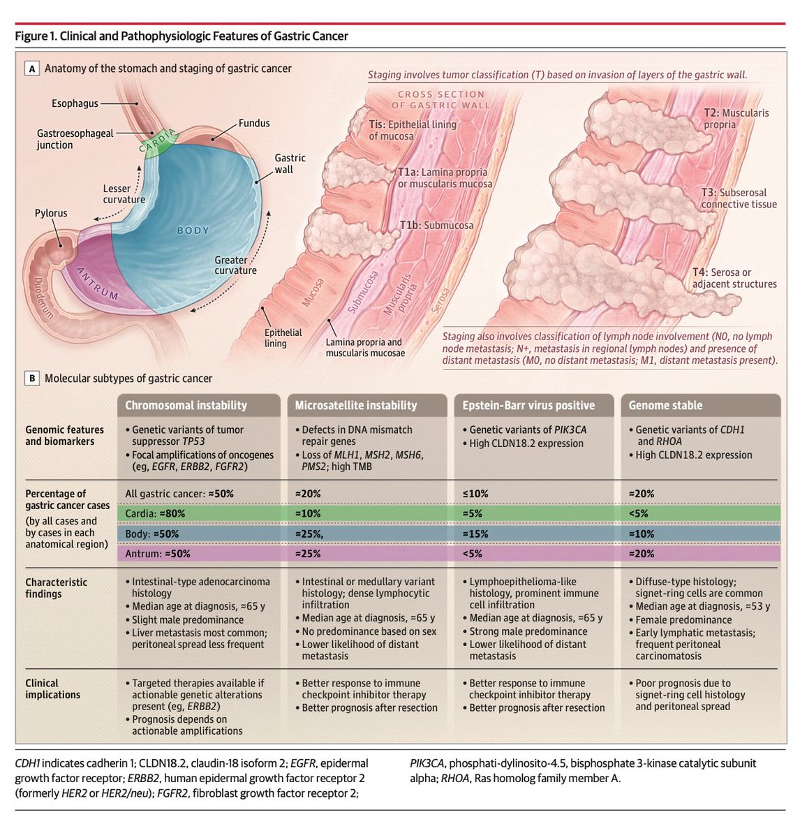 sepdigestiva's tweet photo. Cácer gástrico, la última revisión, en JAMA (2026). Puntos clave:

🟢 Indicar endoscopia en dispepsia >50 años o síntomas de alarma; aunque cada vez es más frecuente aún en <50 años. 

🟢 Biomarcadores: buscar HER2, PD-L1, CLDN18.2 y MMR. Estos definen terapias dirigidas (ej. Zolbetuximab si CLDN18.2+, Trastuzumab si HER2+).

🟢 Manejo Perioperatorio: El esquema FLOT es estándar en estadio II/III. En deficiencia de MMR (dMMR), se sugiere inmunoterapia neoadyuvante

🟢 Estadificación: Laparoscopia diagnóstica con lavado es mandatoria pre-resección curativa; TC y PET tienen baja sensibilidad para metástasis peritoneales.

🟢 Pronóstico: Supervivencia a 5 años <10% en metastásico. La 1ª línea es Quimio + Inmunoterapia/Target según perfil molecular (ej. Nivolumab)

rt @LuisOliverio