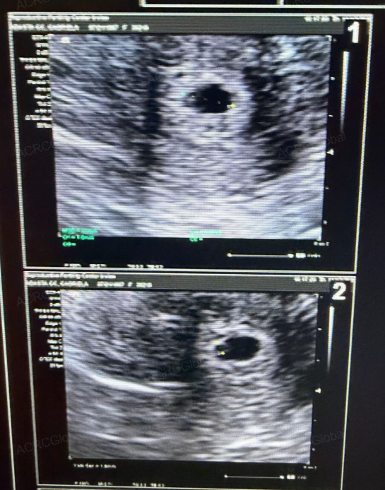 MARGJP22's tweet photo. 本日は、胚移植後に着床、妊娠が確認されて、5週目の心拍確認のお写真です🥰
代理出産の最初の大きな節目である「胚移植」後、無事に着床したら、この心拍確認が妊娠の成功を確信できる重要なポイントです✨

様々な要因が重なって実現する妊娠確定の瞬間、これほど喜ばしいことはありません🥰🌟 https://t.co/yka33pkQxV