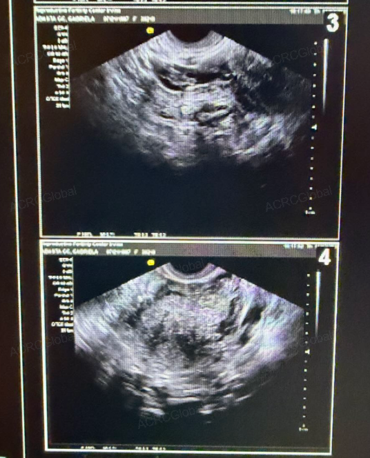 MARGJP22's tweet photo. 本日は、胚移植後に着床、妊娠が確認されて、5週目の心拍確認のお写真です🥰
代理出産の最初の大きな節目である「胚移植」後、無事に着床したら、この心拍確認が妊娠の成功を確信できる重要なポイントです✨

様々な要因が重なって実現する妊娠確定の瞬間、これほど喜ばしいことはありません🥰🌟 https://t.co/yka33pkQxV