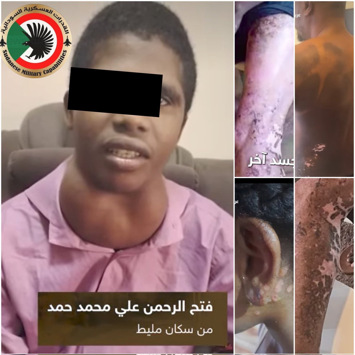 Sudanesearmy1's tweet photo. - بيان للرد على مزاعم وتقارير قناة Sky News Arabia بشأن بث شهادات الشهود "لأستخدم الأسلحة الكيميائية" في السودان

- تابعنا في منصة القدرات العسكرية السودانية ما بثّته قناة Sky News Arabia مجدداََ حول بإعادة تدوير  مزاعم إستخدام الأسلحة الكيميائية في السودان وما رافق ذلك من عرض صور وشهادات فردية وتوصيفات "طبية غير موثقة" في محاولة لتثبيت سردية سياسية عبر أدوات إعلامية لا تستند إلى أي أساس فني أو قانوني معتمد دولياََ وتؤكد المنصة للرأي العام المحلي والمهتم أن ما ورد في التقرير يمثل نموذجاََ كلاسيكياََ غير "متعوب عليه" لتوظيف الصورة والإنفعال بدل الدليل والإستنتاج بدل الإثبات.

- من المثير للأستغراب انه ولأول مرة في التاريخ الحديث أن تتولى قناة إخبارية مهمة دور منظمة حظر الأسلحة الكيميائية (OPCW) فتُصدر أحكاماََ إتهامية دون إخطار رسمي للمنظمة ودون إرسال فرق تقصي حقائق قادرة على  جمع عينات بيئية أو بشرية أو حتى إجراء تحاليل مخبرية معتمدة وهذة سابقة خطيرة تنقل الإتهام من مساره القانوني الدولي إلى مسار إعلامي "مسيّس" بما يشكل خرقاََ للأعراف الدولية الخاصة بالتعامل مع قضايا الأسلحة المحظورة.

- تعتمد القناة بشكل أساسي على صور لضحايا بزعم إصابات كيميائية، بينما الحقيقة العلمية واضحة أساسها أن "السلاح الكيميائي لا يُشخّص بالعين المجردة" ولا يشخص بالتوصيفات "الملقنه" ومن المعلوم أن الإثبات يتم عبر عينات للدم والبول وبفحص الهواء والتربة ثم إجراء تحليل مخبري وفق بروتوكولات OPCW أما الصور والشهادات الملقنه فهي لاتعد سوى "مادة إعلامية" لا ترقى إلى دليل قانوني أو فني، كما أن أنماط الجلد التي إستعرضتها القناة في المقاطع المعروضة يلاحظ انها غير منتظمة ومتفاوتة العمق ولا تتبع نمط الرذاذ أو إتجاه الرياح عند الإنتشار بعد الإطلاق من المقذوف كما تجري العادة عند الإستخدام وهو ما لا يطابق الإصابات الكيميائية العسكرية المعروفة. 

- أظهرت القناة كذلك سابقة طبية غير مسبوقة بعرض حالة لشخص يعاني من "تورم وتضخم كبير في الرقبة" في سياق تأكيد أن المدعو فتح الرحمن قد نتجت له بعد إستنشاقة لمادة كميائية في مدينة "مليط" بعد غارة جوية  "بسلاح كيميائي" وهنا نؤكد علمياََ أن الأسلحة الكيميائية لا تُسبب تضخماََ موضعياََ مزمناََ في الرقبة "بهذا الشكل" فالإنتفاخ الظاهر يتوافق طبياََ مع حالات مثل تضخم الغدة الدرقية (Goiter) أوتضخم العقد اللمفاوية أو أكياس خلقية أو دهنية أو إلتهابات مزمنة أو أورام حميدة وهذه الحالات تتطور ببطء عبر "أشهر وسنوات" وليس نتيجة تعرض كيميائي"مستنشق" بينما ومن المعلوم أن تأثير السلاح الكيميائي يكون حاداََ ومفاجئاََ وجهازياََ عاماََ يصيب الرئة والأعصاب والجلد بشكل واسع ولا يُنشئ كتلاََ موضعية مزمنة في الرقبة وبالتالي فإن الربط بين هذا التورم والسلاح الكيميائي يُعد تضليلاََ سطحياََ وطبياََ صريحاََ. 

-إدعت القناة كذلك في تقريرها أن السلاح الكيميائي قد تسبب في حالات إجهاض من "الأرحام"دون أي سند علمي والحقائق الطبية المعروفة تؤكد أن الإجهاض الكميائي لا يحدث إلا في حالات تسمم جهازي شديد جداََ ويتطلب تعرضاََ عالي التركيز ومطولاََ ولا يُستدل عليه عبر روايات إعلامية أو صور فردية أو قصصاََ، الولايات المتحدة الأمريكية "نفسها" ليس لديها أي ربط معروف يربط بين تعرض محدود مزعوم كما الإتهامات التي لفقتها بإدعاء الأثر المحدود وحدوث إجهاض جماعي دون توثيق مخبري "صارم" وعليه فإن هذا الطرح يدخل في نطاق الإثارة الإعلامية لا التوصيف العلمي. 

- ما قامت به Sky News Arabia ليس تحقيقاََ ولاموادََ صالحة كأدلة ولا يعد سوى تثبيت رواية سياسية بالصور مع تعميم حالات طبية فردية. 

- قفزت القناة الإخبارية من "العرض إلى الإتهام" في تجاوز حاد للمسارات الدولية المعهودة والمختصة، فيما من شأنه أن يمثل خطراََ على المهنية الإعلامية وعلى منظومة العدالة الدولية. 

- تؤكد منصة القدرات العسكرية السودانية أنه لا يوجد نمط إصابات كيميائية في كل ماعرض من "المعطيات المقدمة" وما يوجد فقط توظيف إعلامي مسيس وعليه فإن ما يُطرح ليس ملفاََ كيميائياََ كما تدعي "القناة" بل مشروع ضغط سياسي يُدار عبر "الصورة" بدلاََ من المختبر وعبر الشاشة بدلاََ عن القانون.
