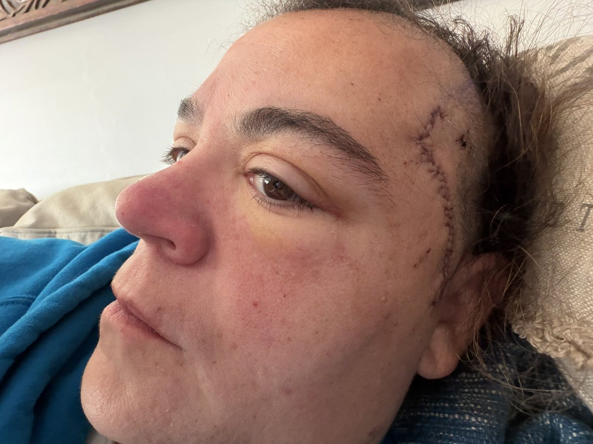 jackiegee81's tweet photo. Just wanted to let the @nyjets and @woodyjohnson4 knowthat I was diagnosed with a rare brain disorder called moyamoya which causes mini strokes and I had brain surgery on Monday and I’m back home and I’m still a @nyjets fan. #jetsfanforlife https://t.co/Bn9xRwLDUa