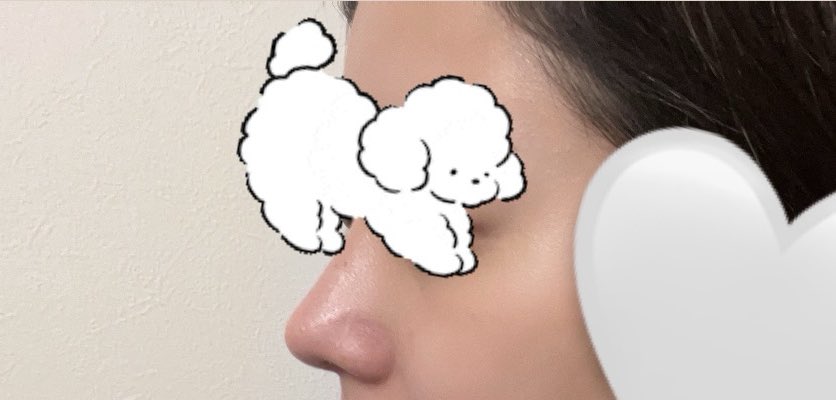 #luho整形外科

 dtもう終わったかな！！
次は口横のもたつきと フェイスライン整えたいなあ..

luho でよかった♡