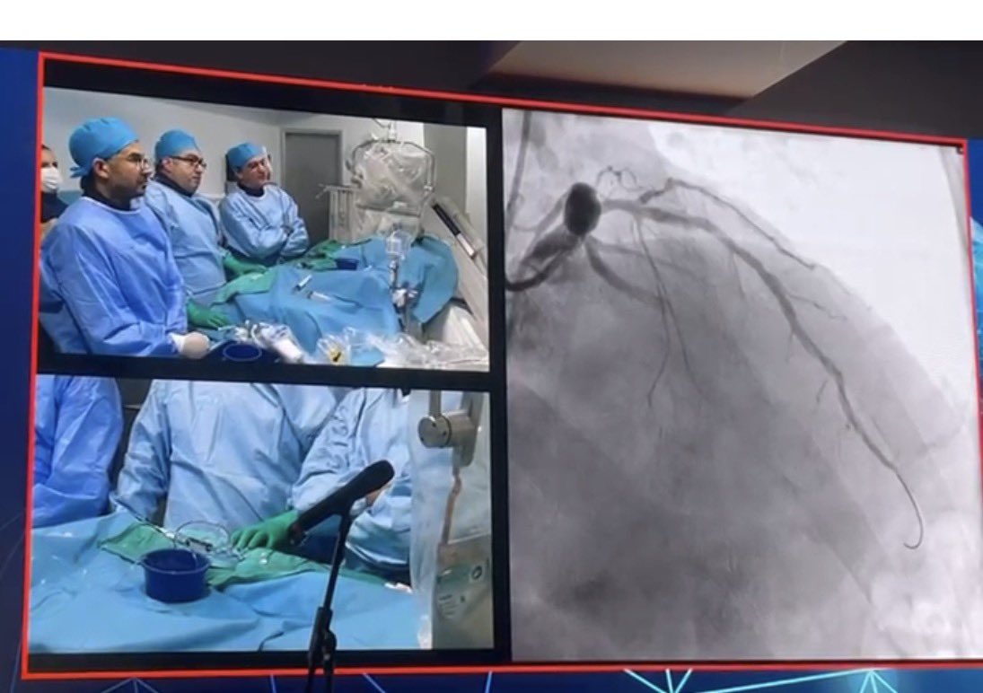 m_degertekin's tweet photo. We have just finished live transmission from Yeditepe University hospital cath labs. to #JIMGISE2026 meeting treating patient with only DCB  of LAD, D and OM. This is important collaboration with JIMGISE and #TSC. Looking forward for more activities. #DCB #cardiology #selution https://t.co/TAIOe5g419