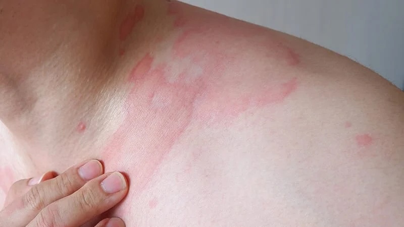 Aller_MD's tweet image. Chronic Urticaria Separating Myths From Medical Evidence: new data challenge common beliefs about antihistamines, corticosteroids, and vaccines in chronic urticaria, with practical implications for clinical counselling. medscape.com/viewarticle/ch…