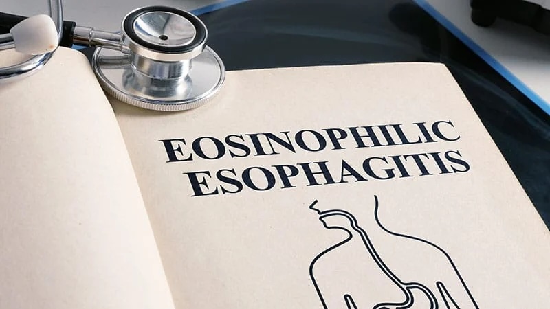 Aller_MD's tweet image. Higher Rates of #EOE and #Food #Allergy Found Mostly in White Male Teens: better adherence to guidelines for food #allergen introduction to infants may improve incidence of EoE and food allergy. medscape.com/viewarticle/hi…