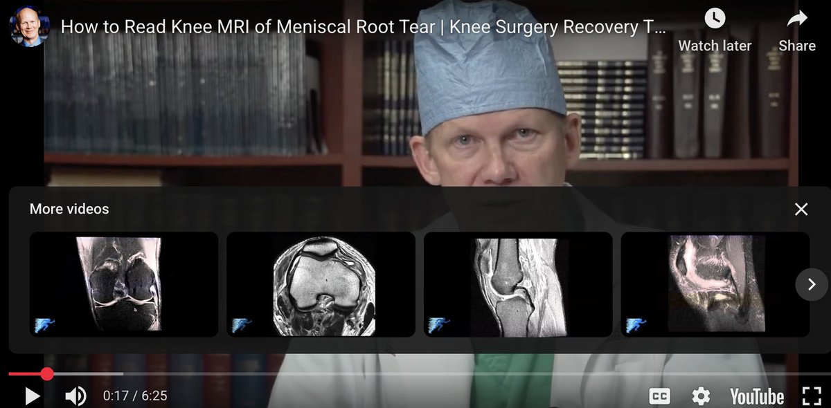 thekneedoc's tweet photo. Meniscal roots attach the meniscus to bone. Tear them, and the knee becomes unstable. Dr. LaPrade’s guide shows how MRIs reveal these tears and why early treatment is essential for recovery. Read here 👉 https://t.co/0xW9nlpzgo #kneeMRI #meniscus #sportsmedicine https://t.co/GLAM27AWS5