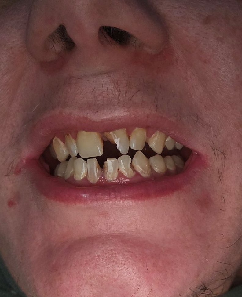 CMerandi's tweet photo. @toddchrisley 

Thank you @toddchrisley for discussing the Suboxone epidemic in prison

This poison is linked to catastrophic dental decay, oral and throat cancers 

It’s being forced on seniors for the treatment of pain 

https://t.co/F23zTbYlj2 https://t.co/zhURRcYAVJ