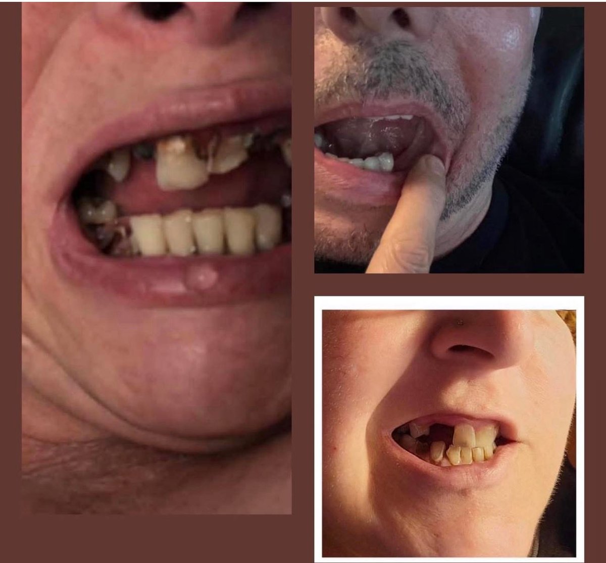 CMerandi's tweet photo. @toddchrisley 

Thank you @toddchrisley for discussing the Suboxone epidemic in prison

This poison is linked to catastrophic dental decay, oral and throat cancers 

It’s being forced on seniors for the treatment of pain 

https://t.co/F23zTbYlj2 https://t.co/zhURRcYAVJ
