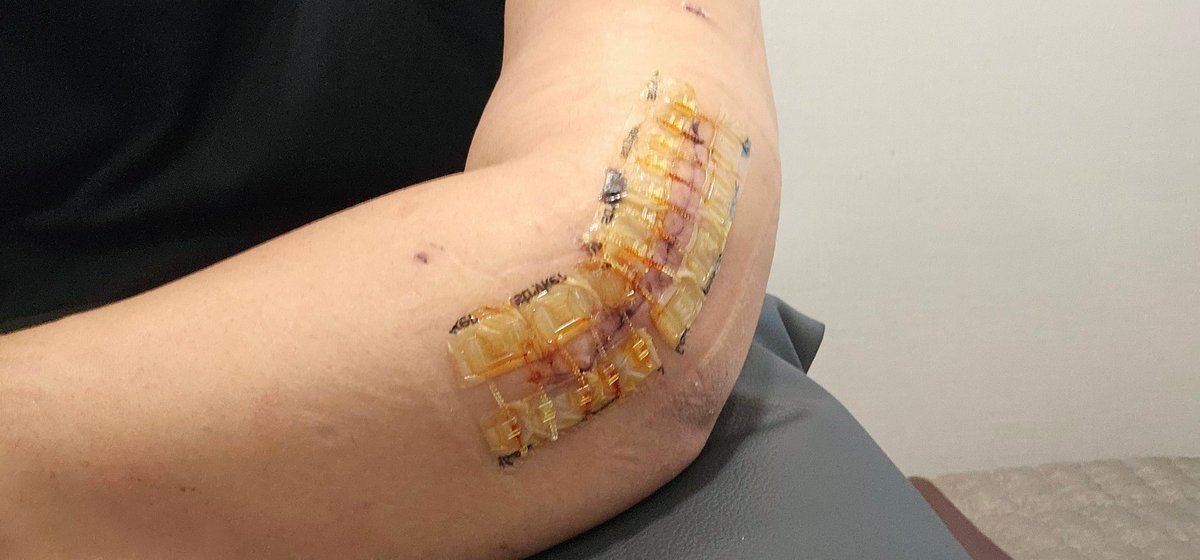 수술한지 2년도 넘었는데...
날씨만 차가워지면 팔에 쑤시고 힘이 없어지네..
아무래도 내뼈가 아니라서 그런가...