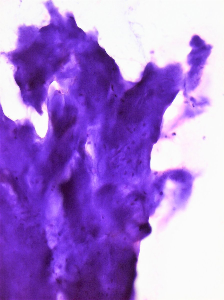 DrCycloPath's tweet image. #CytoQuiz 🔬
A) Chondroma
B) Chondrosarcoma
C) Osteochondroma
D) Chondroblastoma
#Bone #SoftTissue #CytoPath #pathology