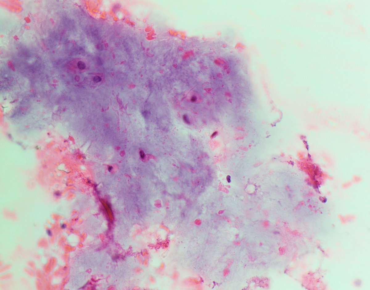 #CytoQuiz 🔬
A) Chondroma
B) Chondrosarcoma
C) Osteochondroma
D) Chondroblastoma
#Bone #SoftTissue #CytoPath #pathology