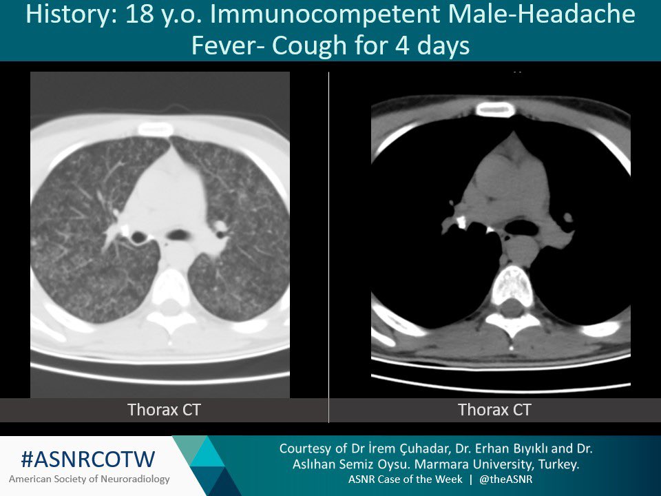 ASNR COTW # 282

Hx: 18 y.o. Immunocompetent Male-Headache, Fever, Cough for 4 days

NO SPOILERS! Give hints in the form of GIFs or answer poll. Answer in 24 hours. 

#neuro #neurorad #radres #FOAMed #FOAMrad #medtwitter #ASNRCOTW