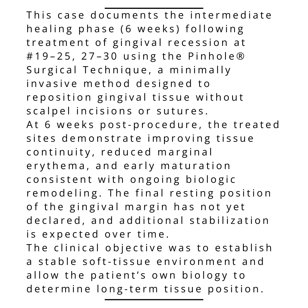 JohnChaodds's tweet photo. Clinical Observation — Gingival Recession (6 weeks)
Pinhole® Surgical Technique | Teeth: #19–25, 27–30
Procedure: 12/30/25 (5:48 PM–6:54 PM) | Interval: 6 weeks
At 6 weeks: improving tissue continuity, reduced marginal erythema, remodeling ongoing. https://t.co/xTiOXYmdlz