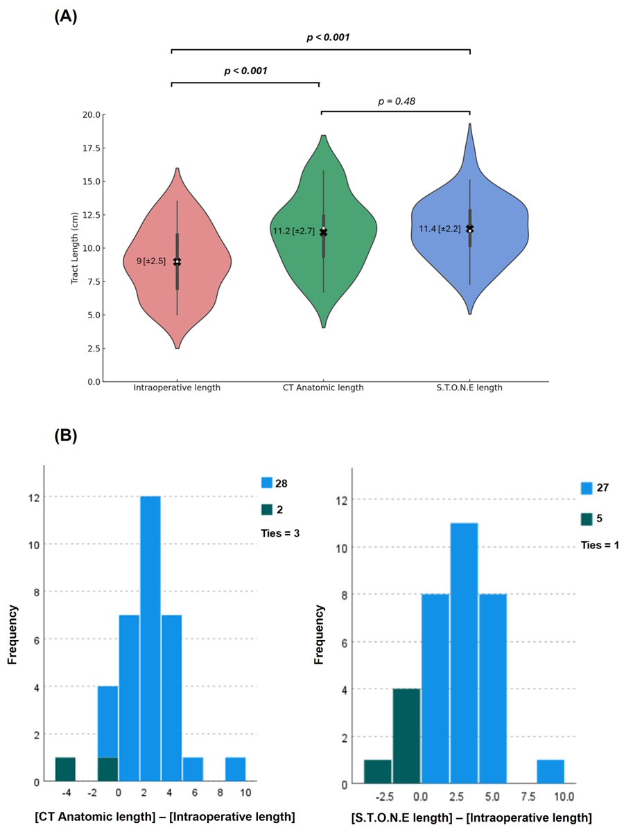 ZivSavin's tweet photo. CT says one thing. Reality says another. In supine PCNL, real-time tract length is shorter than imaging predicts. Surgical planning just got recalibrated. 
https://t.co/V2ZqQAjbAh

@MantuGuptaMD @William_Atallah @KavitaGupta777 @Endo_Society @JEndourology https://t.co/nG2pbNK1dw